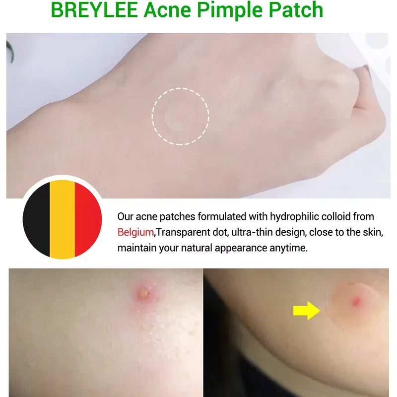 BREYLEE Invisible Acne Pimple Patch Made with Tea Tree Exact Waterproof Breathable 22 Patches Acne Pimple Covering Sticker